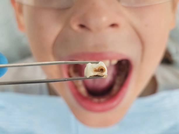 Best Knocked-Out Tooth (Avulsed Tooth) Treatment in Johnstown, PA